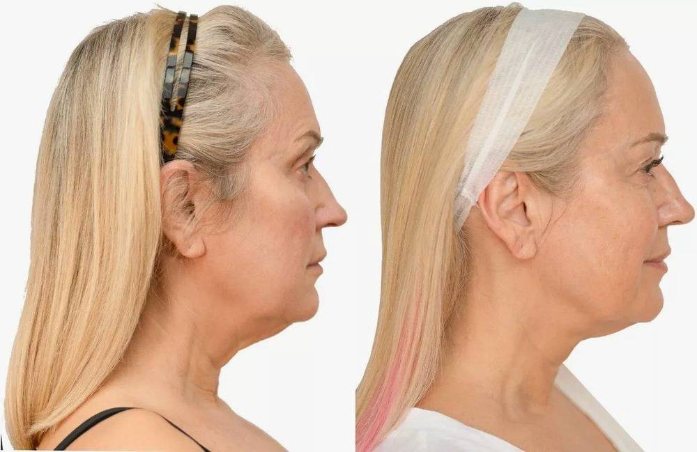 Nicki Chapman — NeoGen plasma before and after, profile