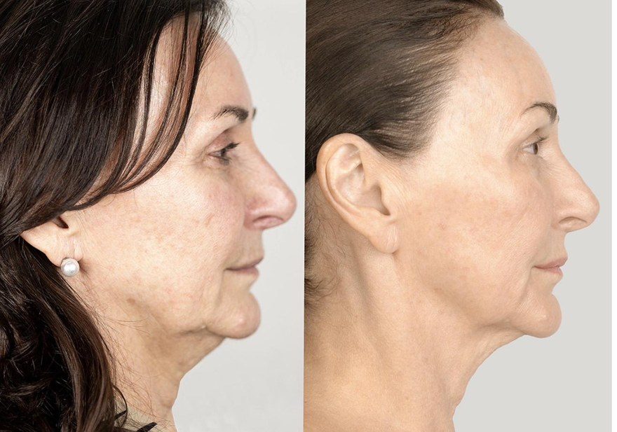 Shirley Ballas — NeoGen plasma before and after, profile