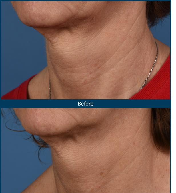 SkinPen — neck 4 treatments