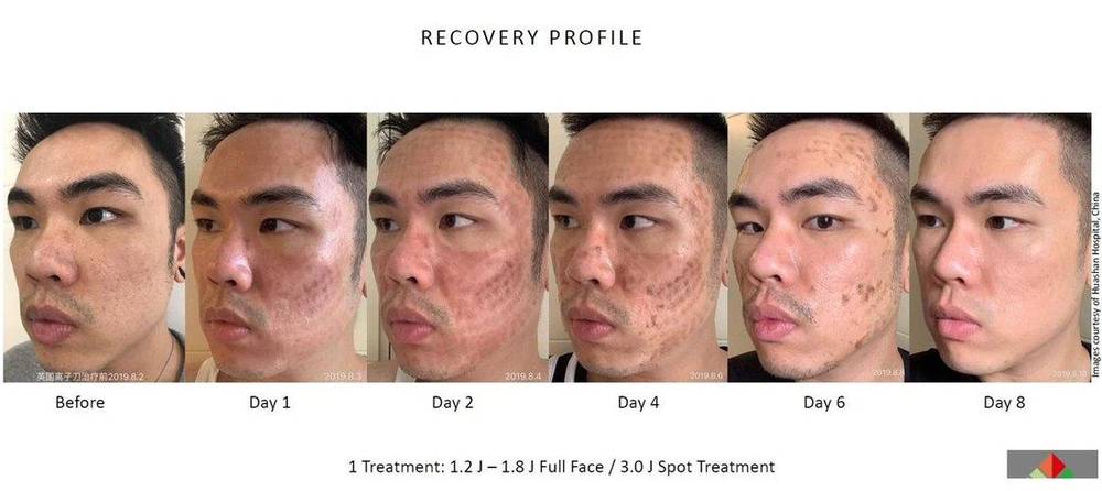 NeoGen EVO recovery profile Day 1 to Day 8
