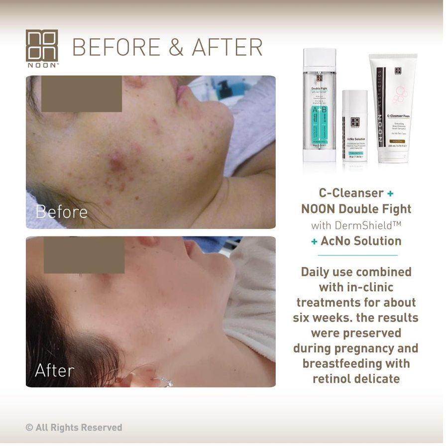 NOON before and after — acne 8 weeks