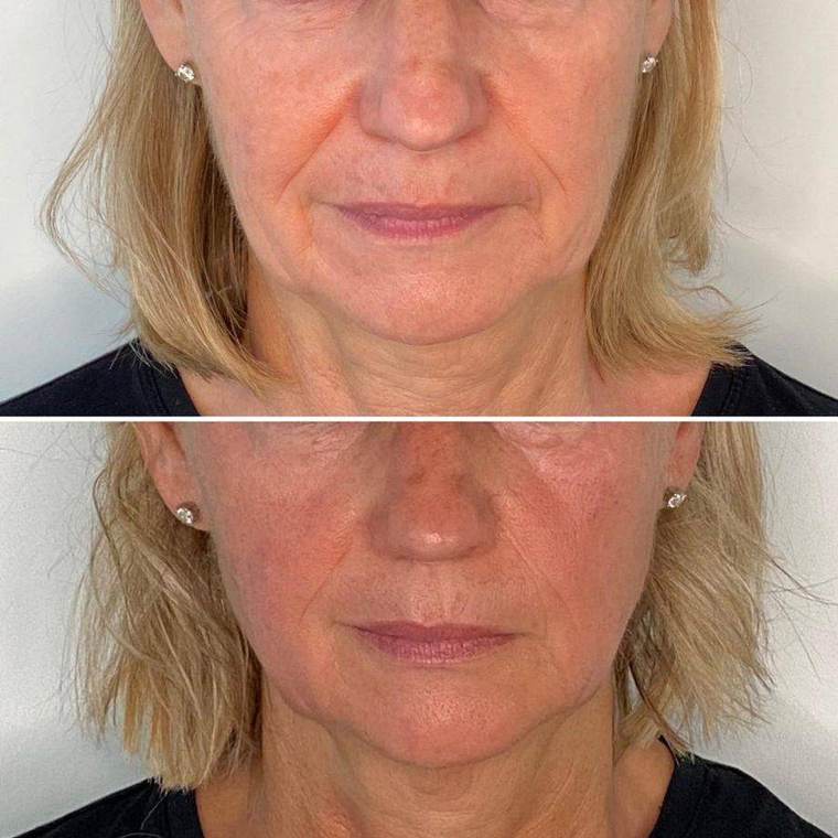 Before and after