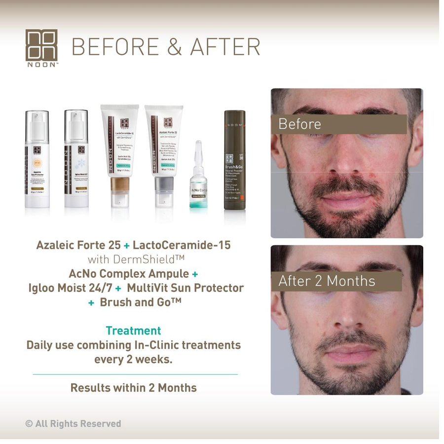 NOON before and after — male acne 2 months