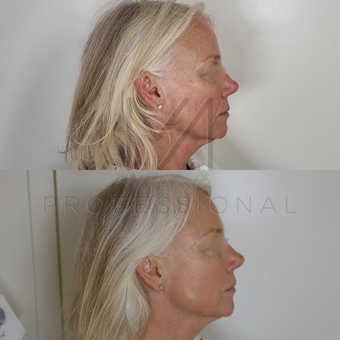 Before & After
