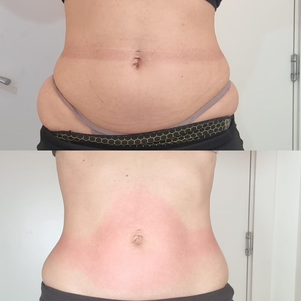 Abdomen — front