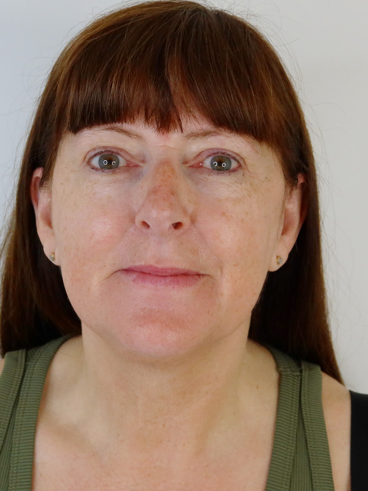 After a Collagen Wave course — front view