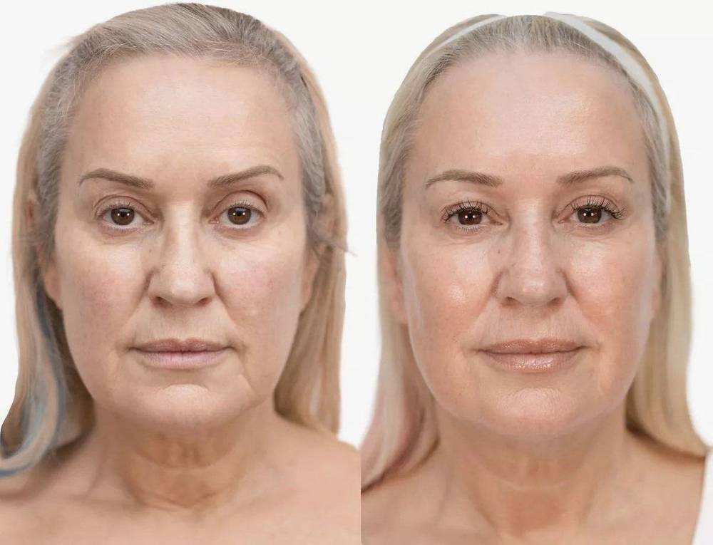 Nicki Chapman — NeoGen plasma before and after, frontal