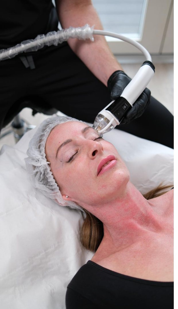 PureDerma RF microneedling treatment in progress