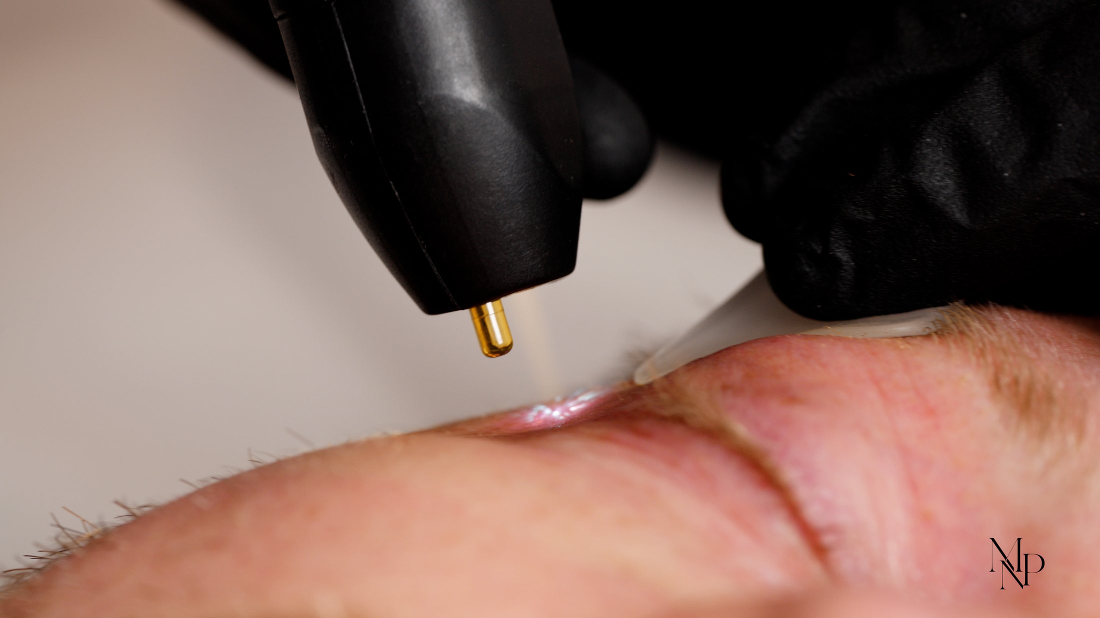 Nitrogen plasma pulse delivered to the skin surface