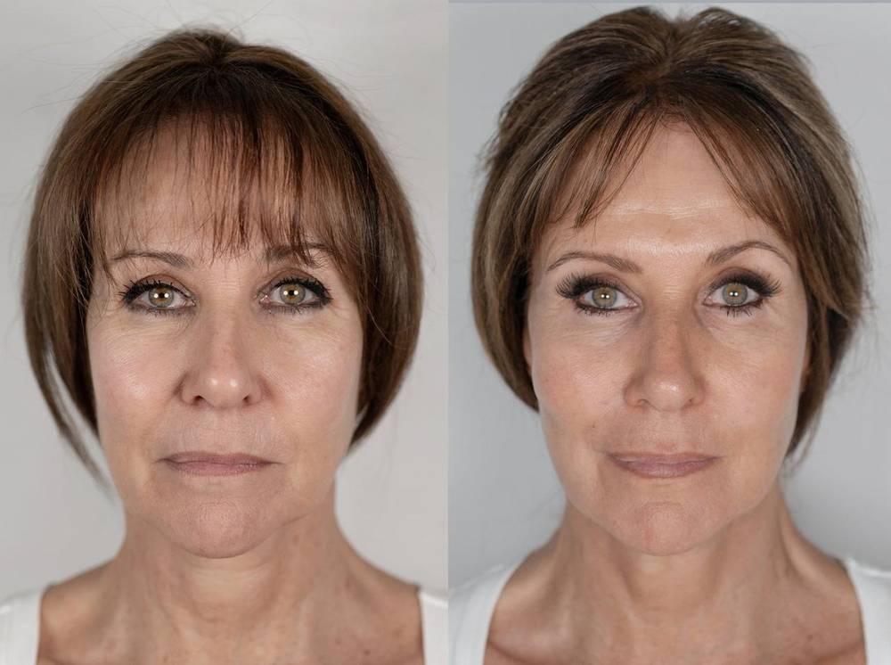 Linda Lusardi — NeoGen plasma before and after, frontal