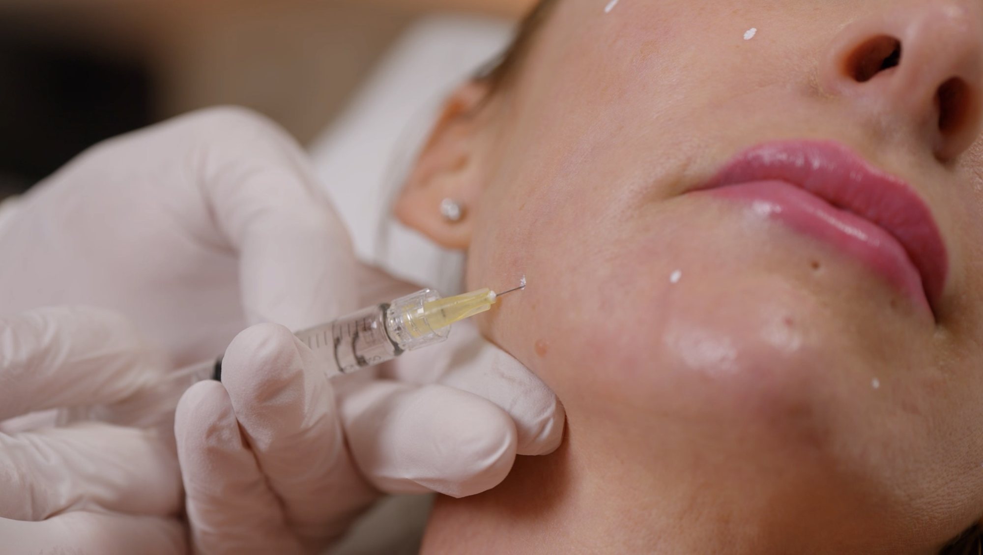Skin booster placed along the jawline at MNP Clinic Hornchurch