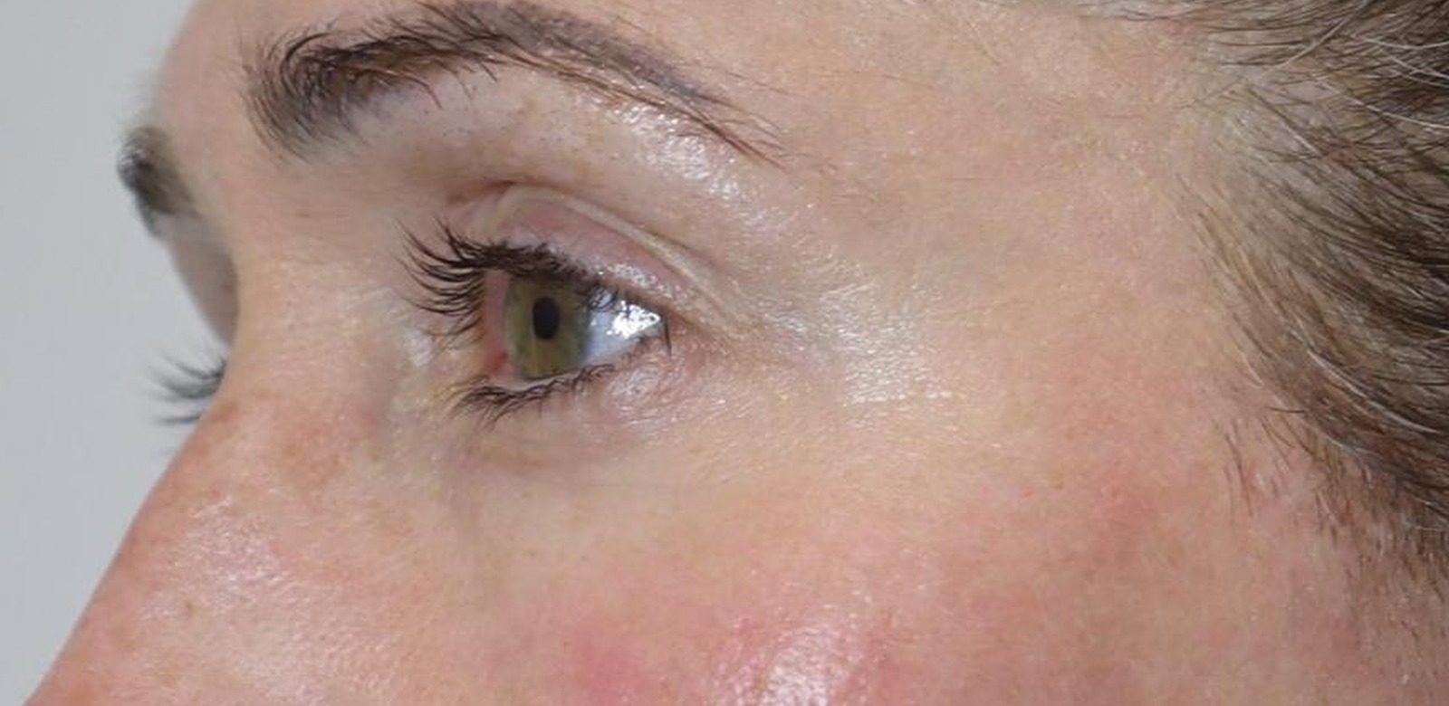 Periorbital — after NeoGen, second angle