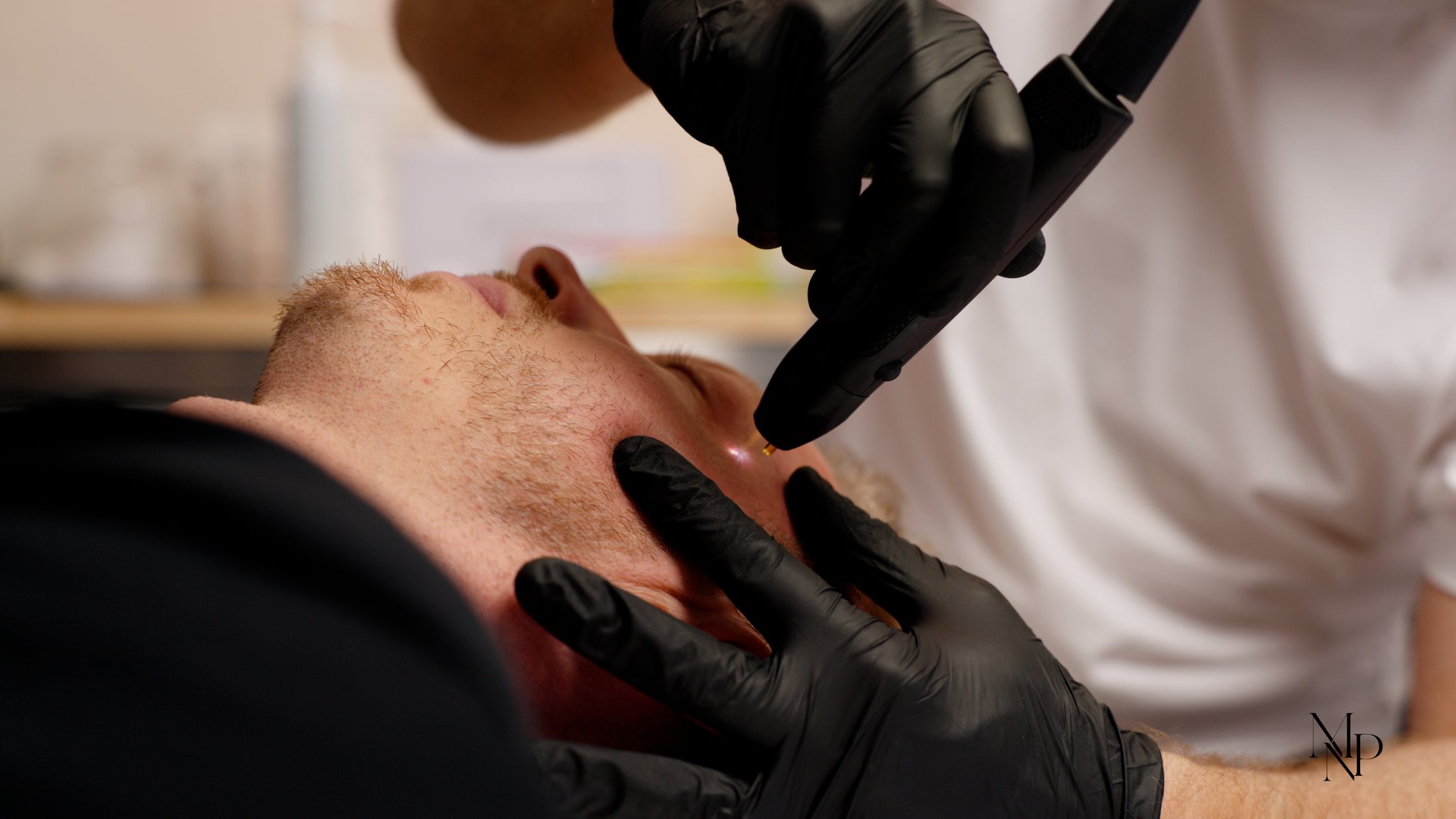 NeoGen EVO treatment across the cheek
