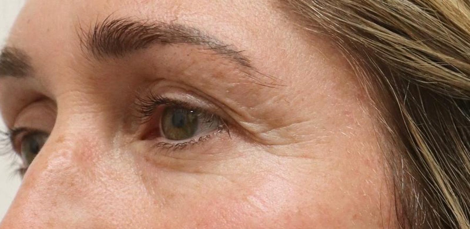 Periorbital — before NeoGen, second angle