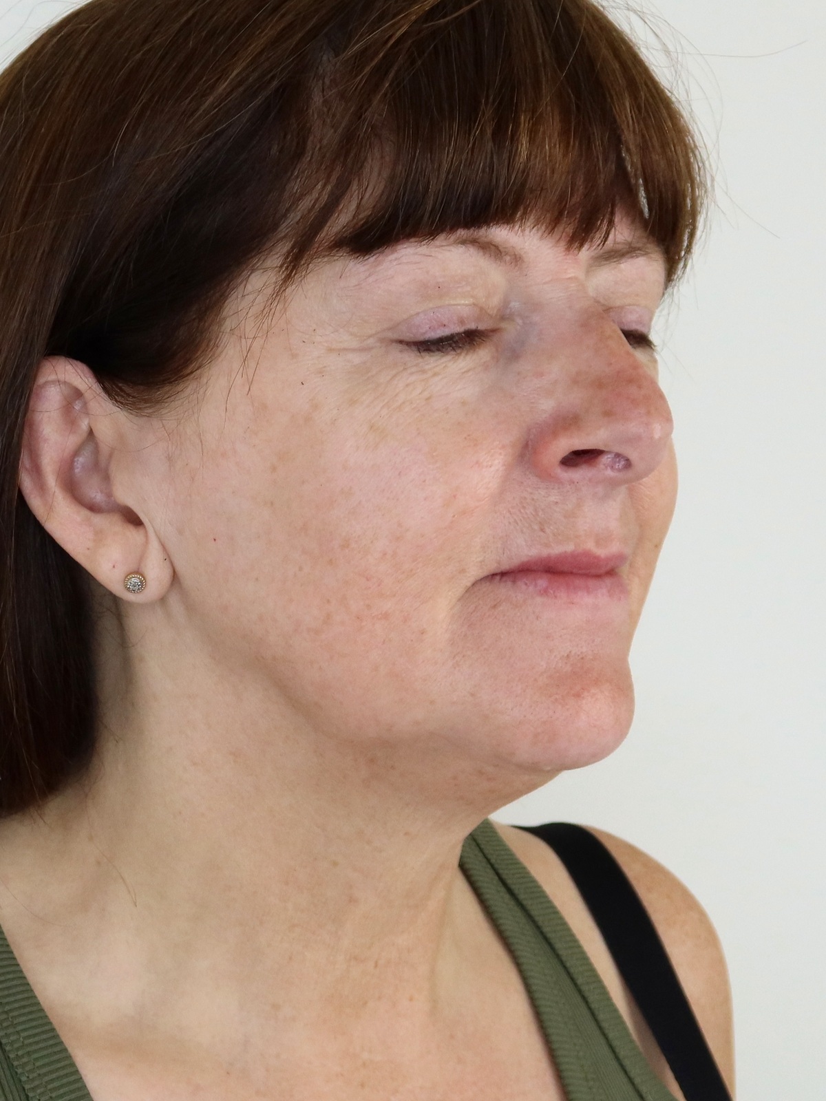 After a Collagen Wave course — three-quarter view