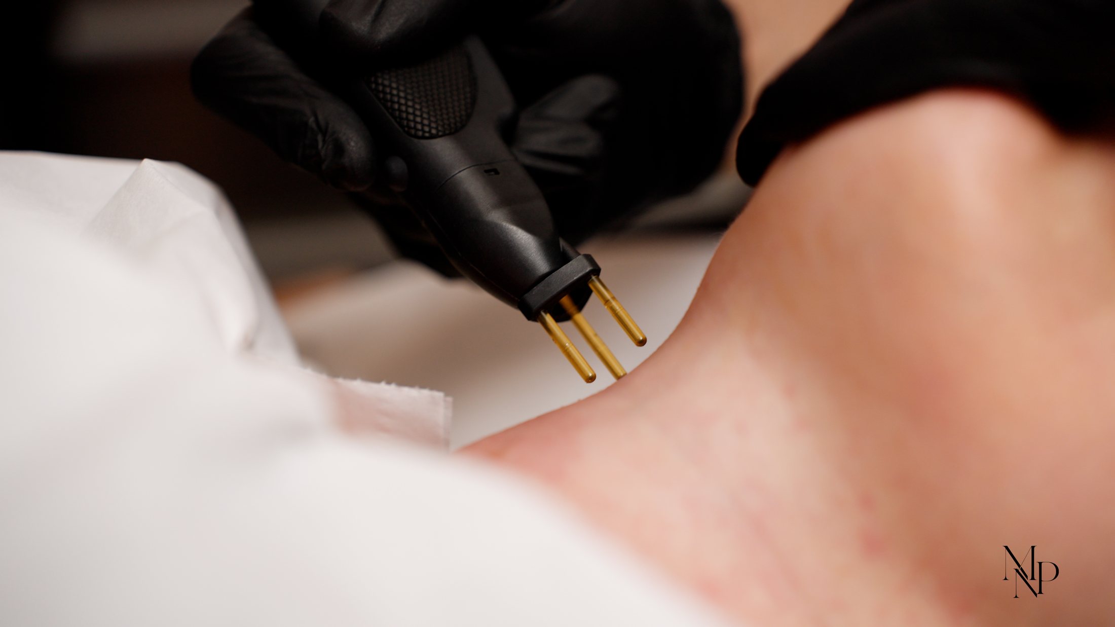 Skin treatment in clinic at MNP Clinic Hornchurch