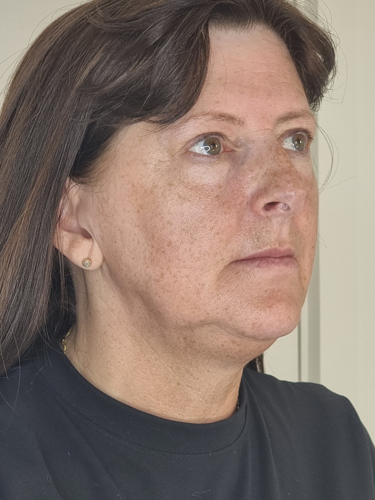 Before Collagen Wave — three-quarter view