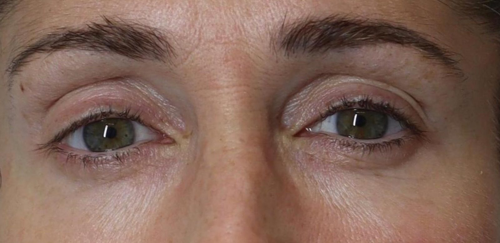 Periorbital — after NeoGen