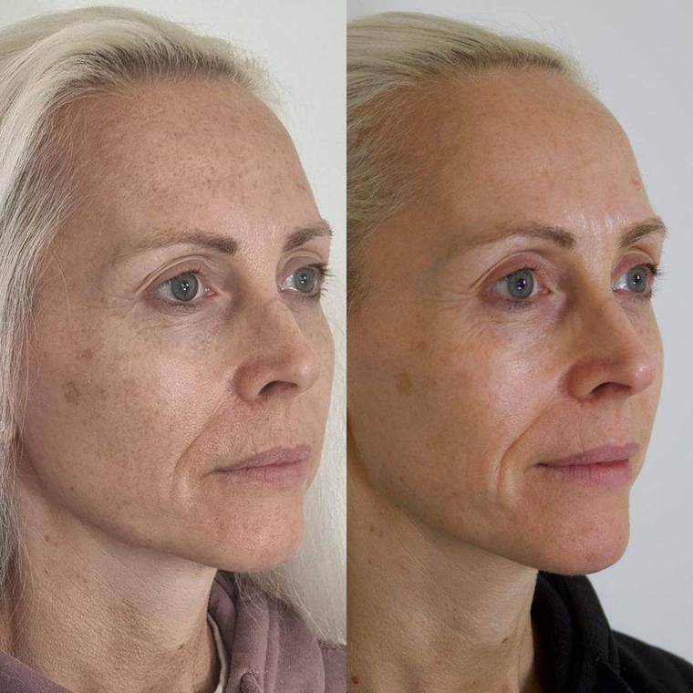 Before and after