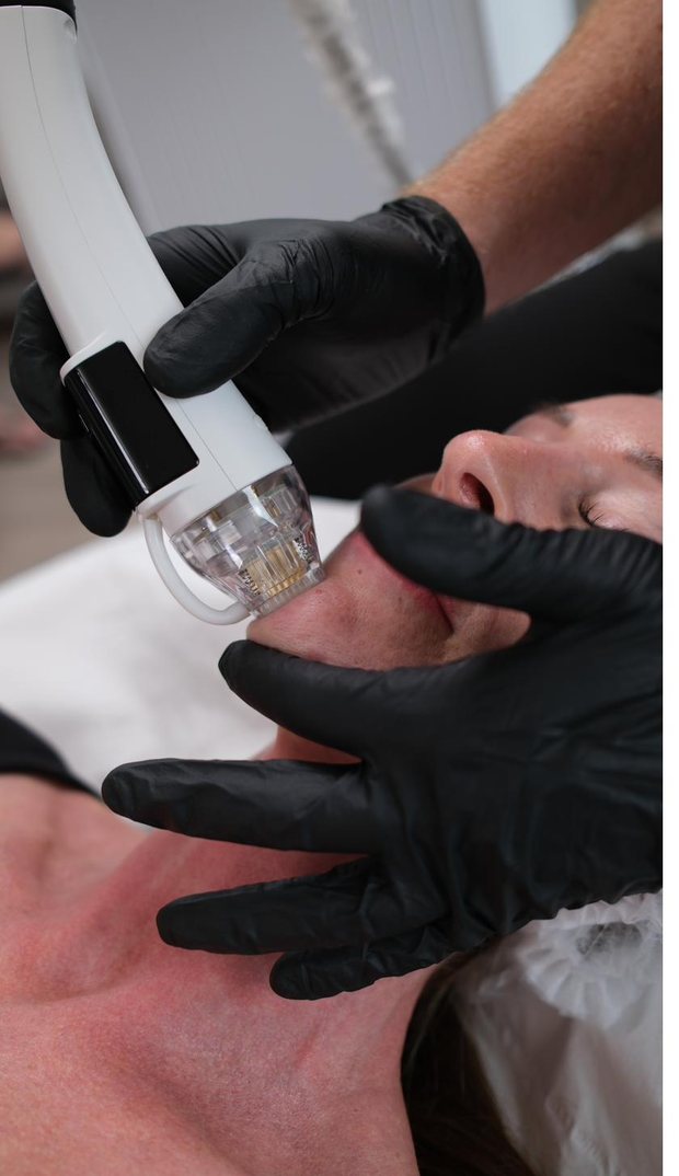 PureDerma RF microneedling along the jawline