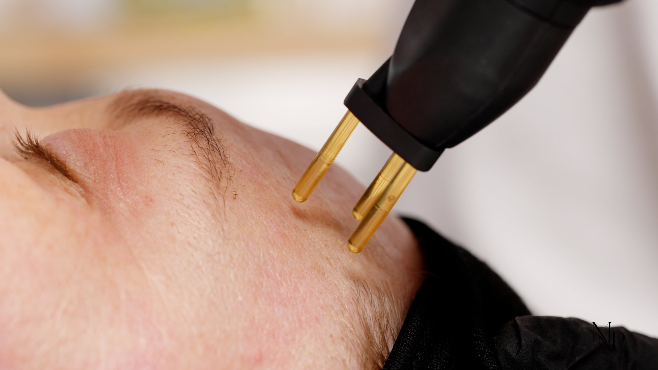 NeoGen EVO applicator in treatment