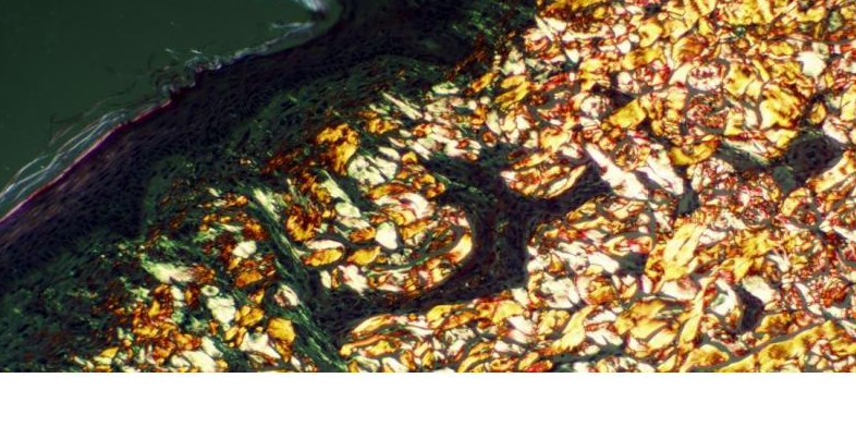 Polarised-light micrograph — new collagen fibres glowing gold in the Zone of Thermal Modification
